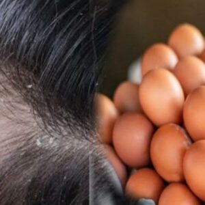home remedies for dandruff