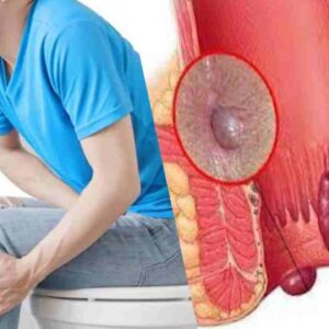 piles home remedies