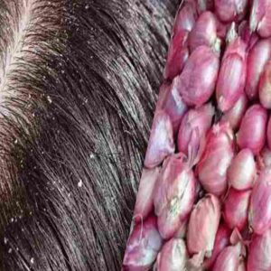 dandruff remedy at home