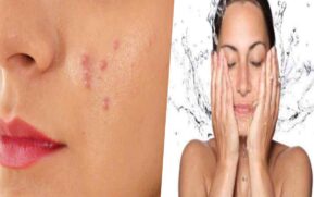 face pimple tips