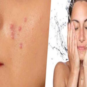 face pimple tips