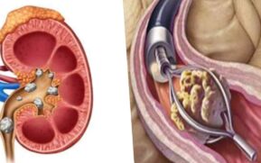 kidney stone surgery