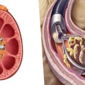 kidney stone surgery