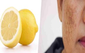 lemon remove dark spots