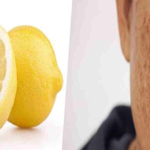 lemon remove dark spots