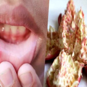 mouth-ulcer-home-remedy