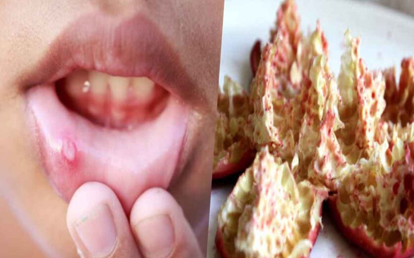 mouth-ulcer-home-remedy