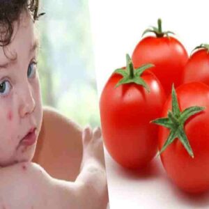 tomato fever