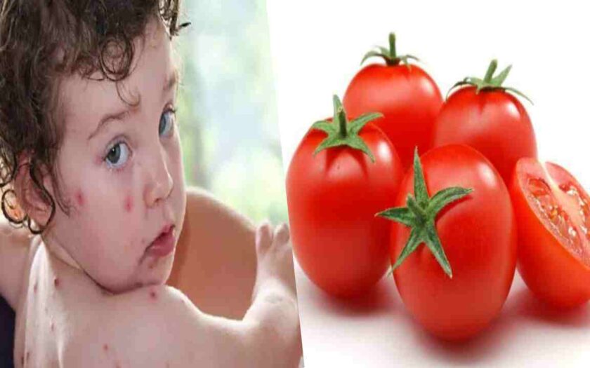 tomato fever
