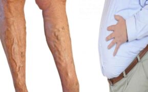 varicose veins