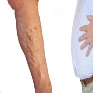varicose veins