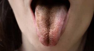 tongue block